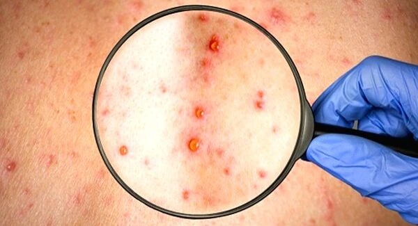 What Is Chickenpox? Know about Symptoms, Treatment, Causes, Diagnosis