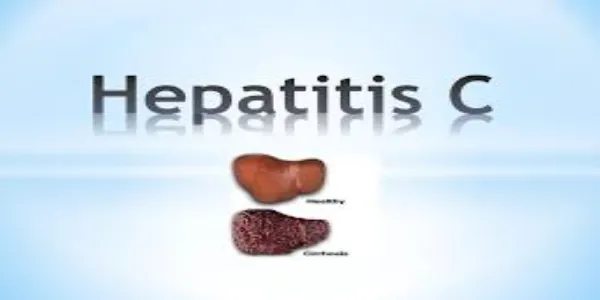 From Diagnosis to Treatment: A Thorough Guide to Hepatitis C From Diagnosis to Treatment: A Thorough Guide to Hepatitis C